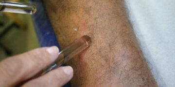 SES alerta para importância de diagnóstico e tratamento de hanseníase