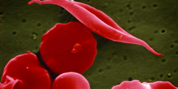 Paciente com anemia genética é curado com técnica de edição do DNA e agora tem vida normal