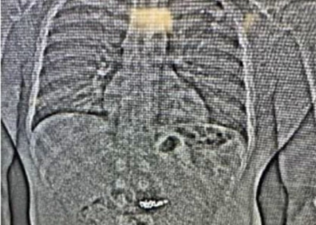 Detetives dos EUA recuperam 4 brincos de diamante 2 semanas após suspeito engoli-los durante prisão