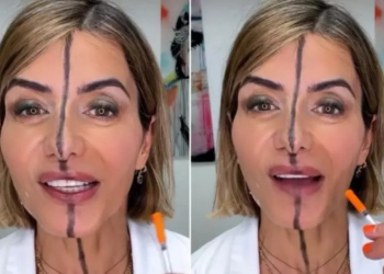 Esteticista aplica botox em apenas um lado do rosto para mostrar efeitos
