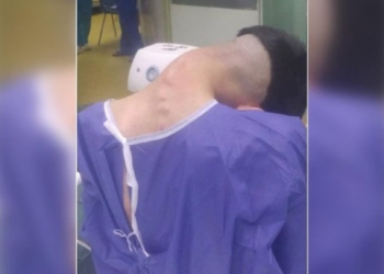 Homem tem síndrome da “cabeça caída” causada por vício