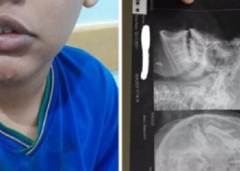 Aluno é espancado em sala de aula e tem nariz quebrado