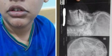 Aluno é espancado em sala de aula e tem nariz quebrado