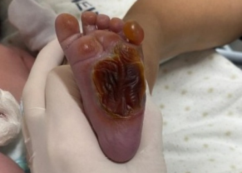 Recém-nascido tem o pé queimado em hospital