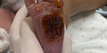 Recém-nascido tem o pé queimado em hospital